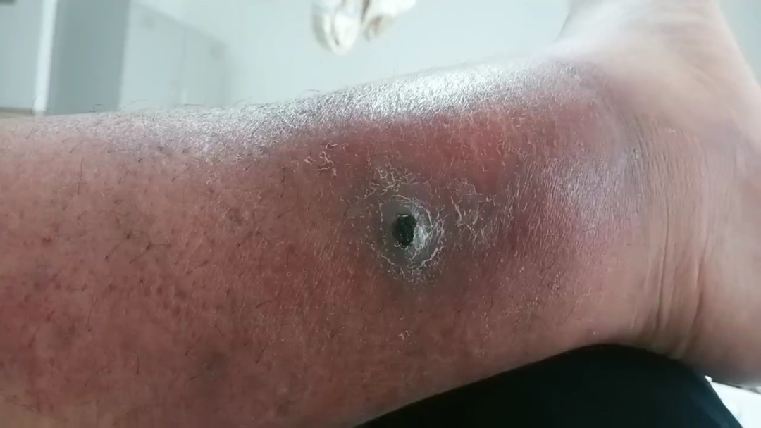 动物门诊用什么x光机青海小伙慕名至甘肃省第二人民医院动物咬伤门诊解“蛇”毒_https://www.jmylbn.com_新闻资讯_第1张