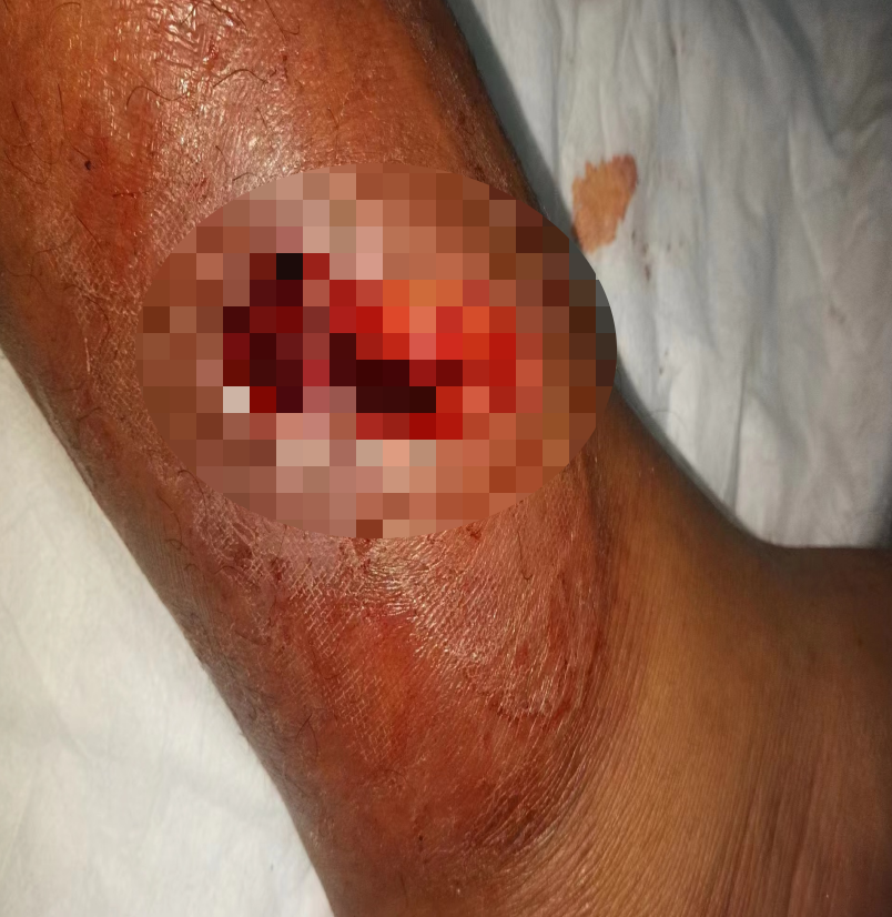 动物门诊用什么x光机青海小伙慕名至甘肃省第二人民医院动物咬伤门诊解“蛇”毒_https://www.jmylbn.com_新闻资讯_第5张