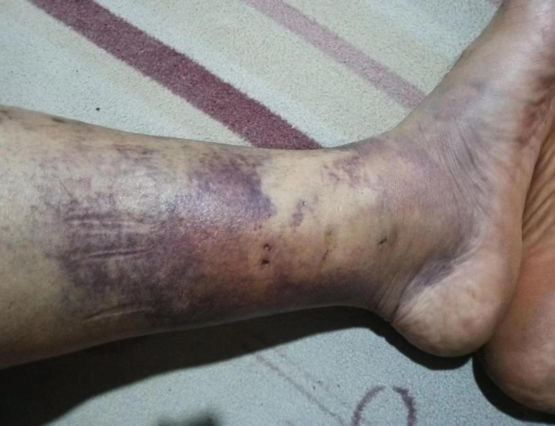 动物门诊用什么x光机青海小伙慕名至甘肃省第二人民医院动物咬伤门诊解“蛇”毒_https://www.jmylbn.com_新闻资讯_第3张