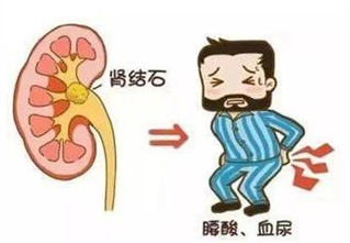 体外碎石b超怎么定位全电脑B超定位体外冲击波碎石│得了输尿管结石别紧张，区中医院碎石科有实招！_https://www.jmylbn.com_新闻资讯_第7张