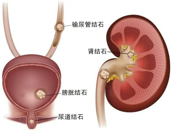 体外碎石b超怎么定位全电脑B超定位体外冲击波碎石│得了输尿管结石别紧张，区中医院碎石科有实招！_https://www.jmylbn.com_新闻资讯_第1张