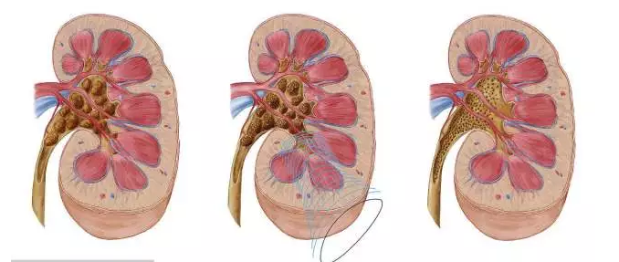 体外碎石b超怎么定位全电脑B超定位体外冲击波碎石│得了输尿管结石别紧张，区中医院碎石科有实招！_https://www.jmylbn.com_新闻资讯_第14张