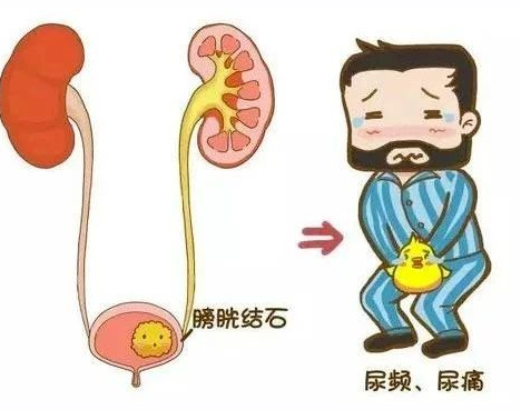 体外碎石b超怎么定位全电脑B超定位体外冲击波碎石│得了输尿管结石别紧张，区中医院碎石科有实招！_https://www.jmylbn.com_新闻资讯_第8张