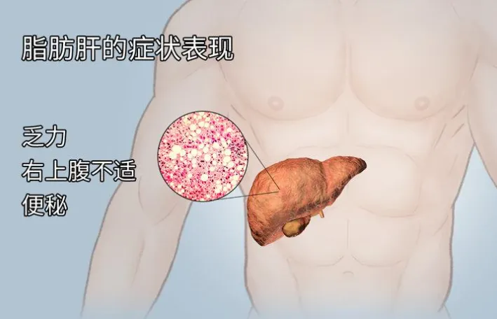 脂肪肝不可怕,正确应对是关键