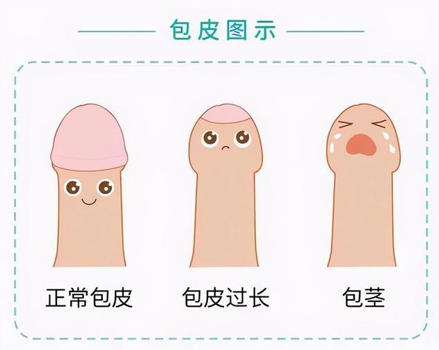 包皮吻合器是什么切包皮有新技术啦!我院开展“包皮环切吻合器”微创手术_https://www.jmylbn.com_新闻资讯_第3张