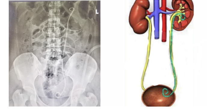 输尿管导管是什么小管道  大学问_https://www.jmylbn.com_新闻资讯_第3张