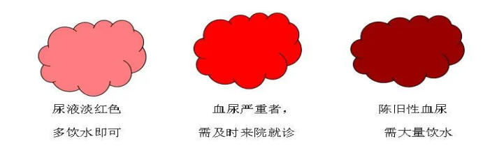 输尿管导管是什么小管道  大学问_https://www.jmylbn.com_新闻资讯_第5张