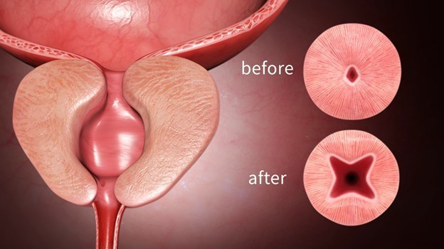 怎么前列腺器械获批FDA！前列腺微创植入器械_https://www.jmylbn.com_新闻资讯_第4张