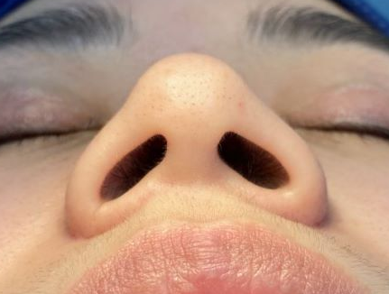 ▼如下图1,鼻槛过长:导致鼻翼基地宽大,鼻翼宽大