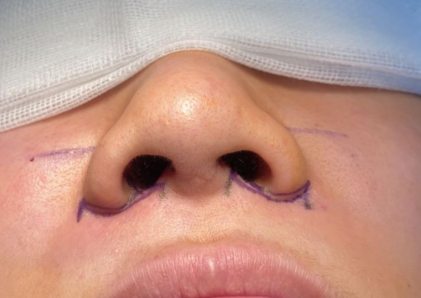 鼻翼缩小术后反弹原因解析-杨杰-爱问医生