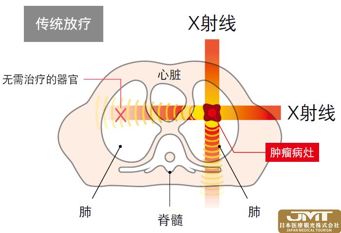 JMT日本医疗——筑波大学附属医院的质子治疗中心介绍②