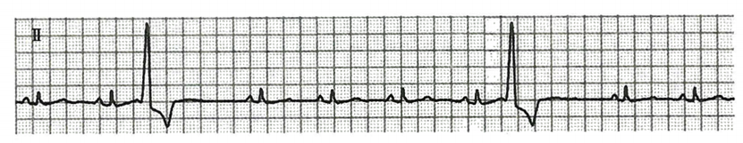 室性早搏的体表心电图定位