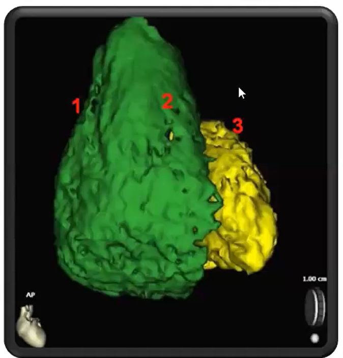 室性早搏的体表心电图定位