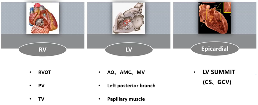 室性早搏的体表心电图定位