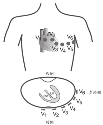 室性早搏的体表心电图定位
