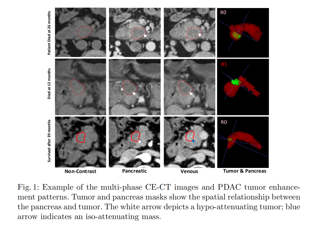 DeepPrognosis：胰腺癌术前手术切缘及存活率预测