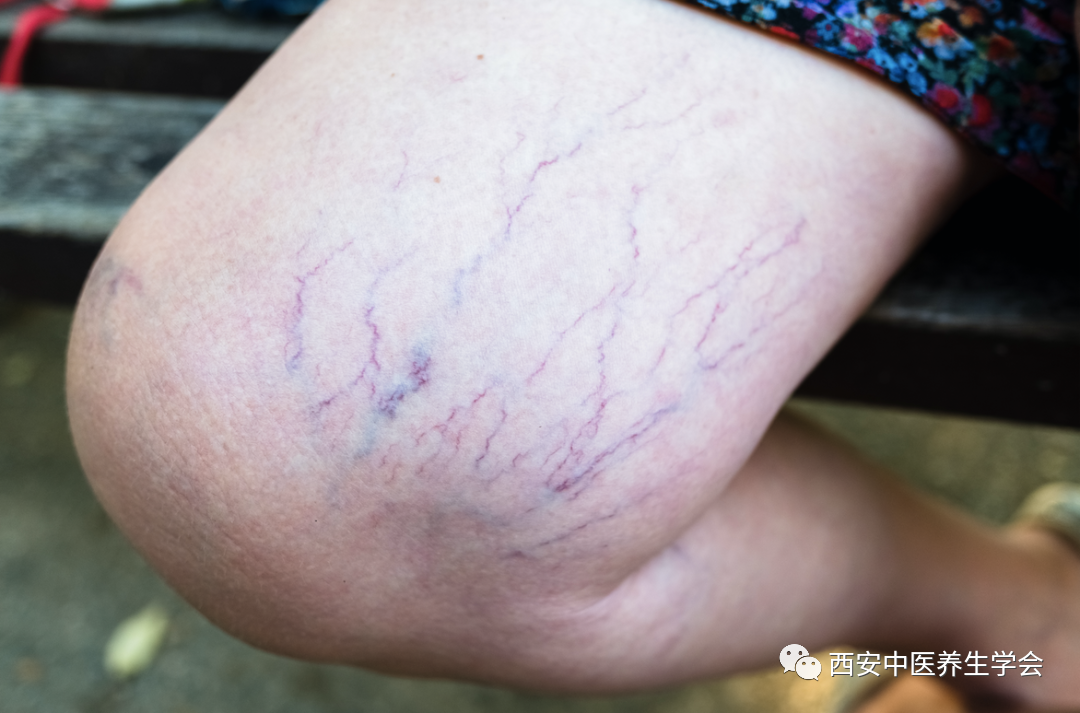 腿上的青筋,三伏天帮你解决-新闻资讯-徐福峰_卫甜_徐一摸_西安德钰堂