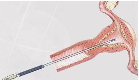 人流刮匙有什么型号不明原因不孕、流产，你做子宫内膜活检了吗？_https://www.jmylbn.com_新闻资讯_第7张