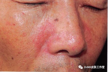 脂溢性皮炎的问与答