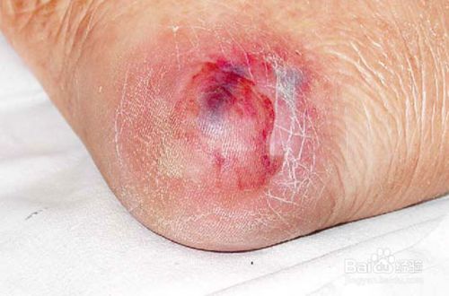 压疮是由于身体局部组织长期受压,血液循环受到障碍,不能适当供给皮肤