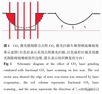 二氧化碳(co2)激光治疗是什么点阵CO2激光综合模式治疗面部凹陷性痤疮瘢痕的临床效果_https://www.jmylbn.com_新闻资讯_第1张