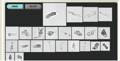 从病理管型看慢性肾脏病的检测