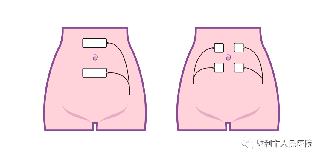 产后康复治疗仪怎么用产后康复治疗——低频仪治疗_https://www.jmylbn.com_新闻资讯_第5张