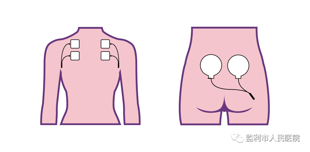 产后康复治疗仪怎么用产后康复治疗——低频仪治疗_https://www.jmylbn.com_新闻资讯_第6张