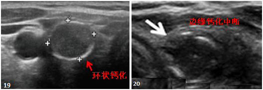 甲状腺结节8mm大吗_2*8mm甲状腺结节_甲状腺结节8mm