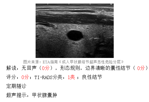 甲状腺结节8mm_2*8mm甲状腺结节_甲状腺结节8mm大吗