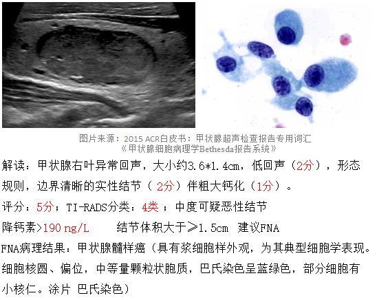 甲状腺结节8mm_2*8mm甲状腺结节_甲状腺结节8mm大吗