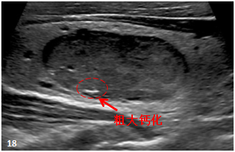 2*8mm甲状腺结节_甲状腺结节8mm大吗_甲状腺结节8mm