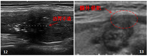 2*8mm甲状腺结节_甲状腺结节8mm大吗_甲状腺结节8mm