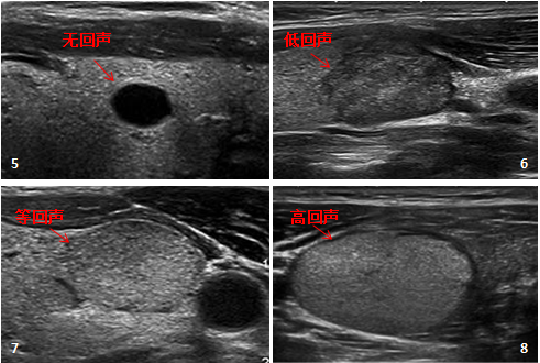 甲状腺结节8mm大吗_2*8mm甲状腺结节_甲状腺结节8mm