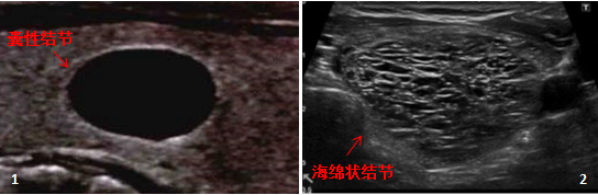 2*8mm甲状腺结节_甲状腺结节8mm大吗_甲状腺结节8mm