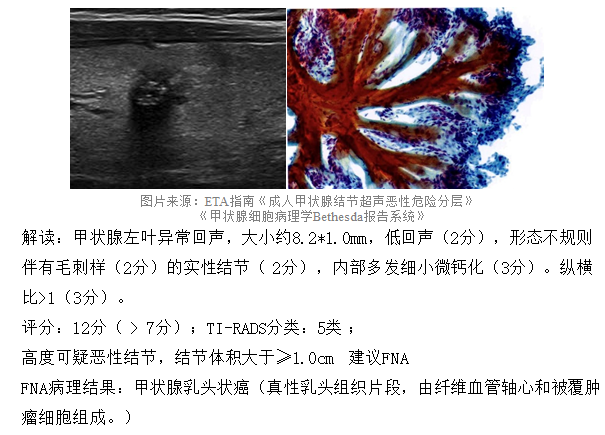 甲状腺结节8mm大吗_2*8mm甲状腺结节_甲状腺结节8mm