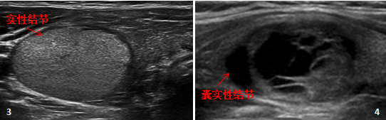 甲状腺结节8mm_甲状腺结节8mm大吗_2*8mm甲状腺结节