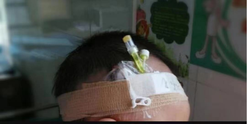 bd留置针怎么使用使用留置针期间的护理，应该怎样做？_https://www.jmylbn.com_新闻资讯_第4张