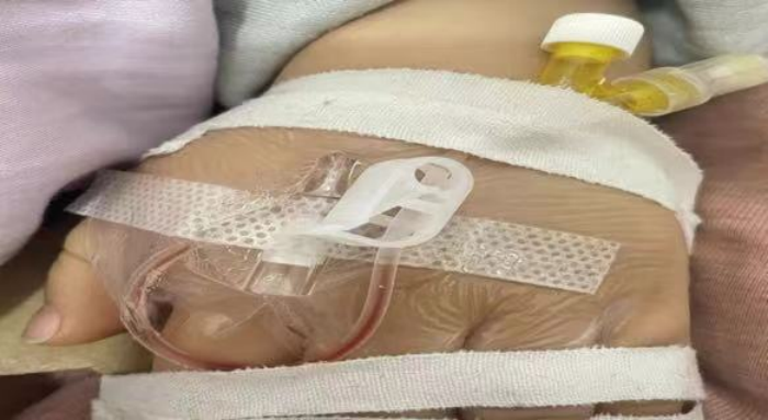 bd留置针怎么使用使用留置针期间的护理，应该怎样做？_https://www.jmylbn.com_新闻资讯_第8张