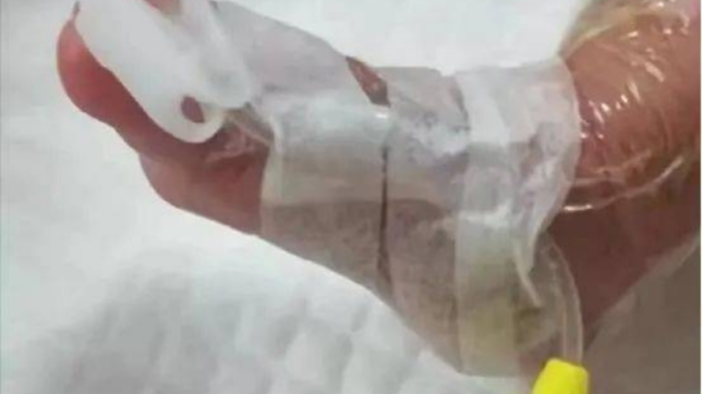 bd留置针怎么使用使用留置针期间的护理，应该怎样做？_https://www.jmylbn.com_新闻资讯_第3张