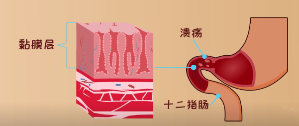 這些癥狀可能是十二指腸潰瘍，教你如何調(diào)理