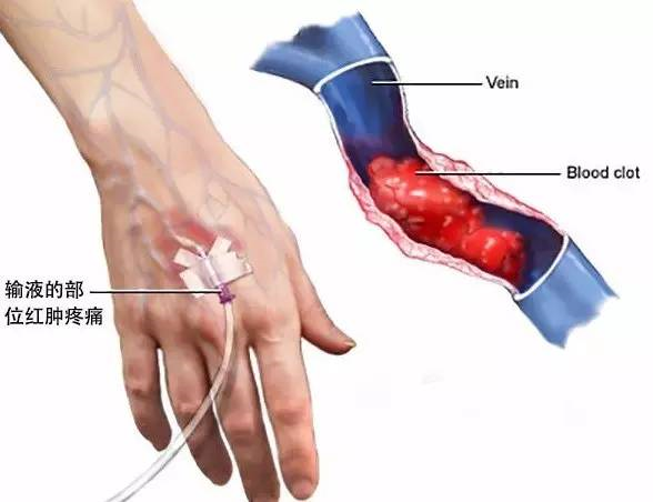 为什么输液要盖块纱布【健康科普】护士，我的手打肿了怎么办？_https://www.jmylbn.com_新闻资讯_第3张