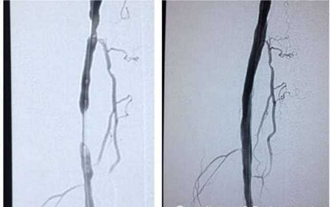 什么是外周支架获批上市！国产新一代外周球囊扩张导管_https://www.jmylbn.com_新闻资讯_第5张