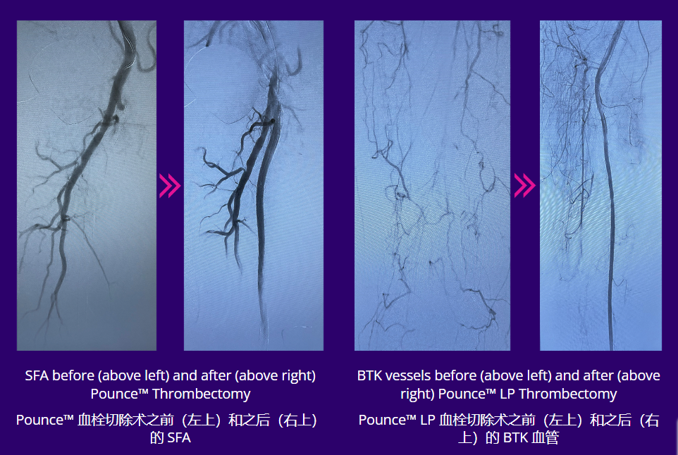 什么是外周支架获批FDA！最大号外周动脉取栓支架_https://www.jmylbn.com_新闻资讯_第11张
