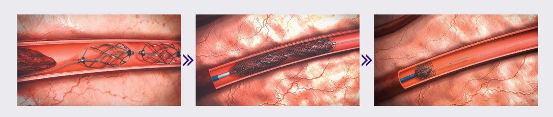 什么是外周支架获批FDA！最大号外周动脉取栓支架_https://www.jmylbn.com_新闻资讯_第10张