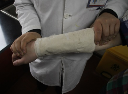 医用骨夹板怎么用竹夹板治疗桡骨远端骨折技术_https://www.jmylbn.com_新闻资讯_第8张