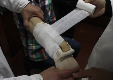 医用骨夹板怎么用竹夹板治疗桡骨远端骨折技术_https://www.jmylbn.com_新闻资讯_第10张