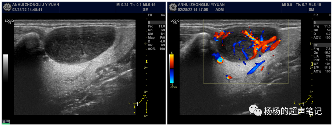 什么是超声容积探头超声基础知识(1)—超声探头的基本构造_https://www.jmylbn.com_新闻资讯_第6张