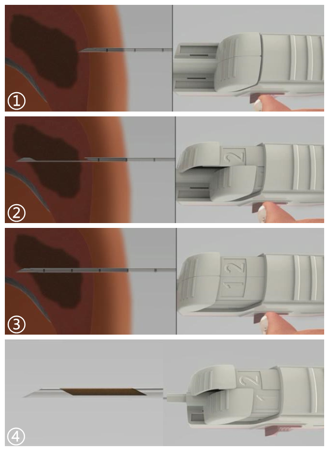 半自动活检针怎么用介入基础知识(1)—活检针分类及切割原理_https://www.jmylbn.com_新闻资讯_第6张
