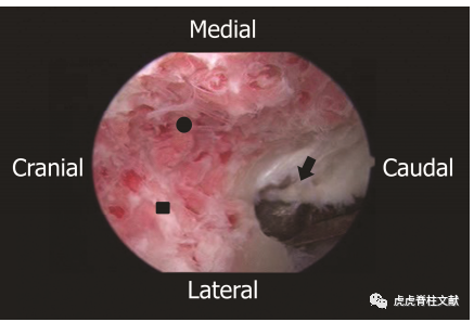 为什么会有单关节器械早读 ｜ 腰椎单边双通道内镜技术诞生的历史沿革_https://www.jmylbn.com_新闻资讯_第16张